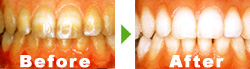 内因性変色before→after
