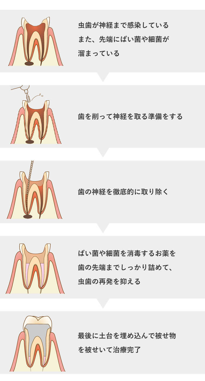 歯 の 根っこ 治療