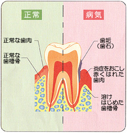 歯周病解説イラスト