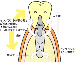 インプラント治療解説図