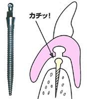 ミニインプラント