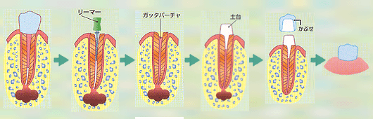 歯の根の治療について