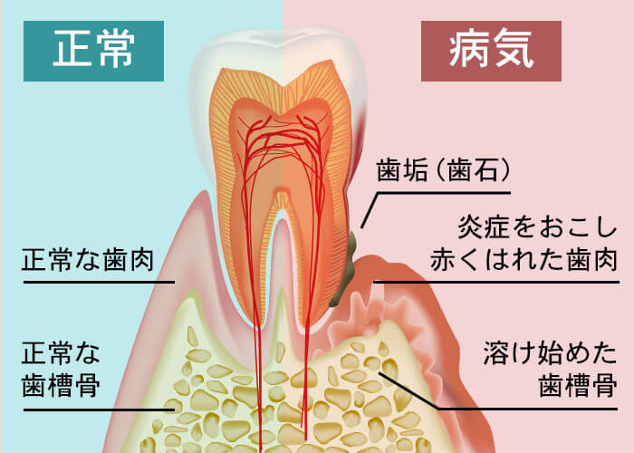 歯周病