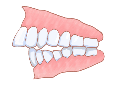 上顎前突（出っ歯）