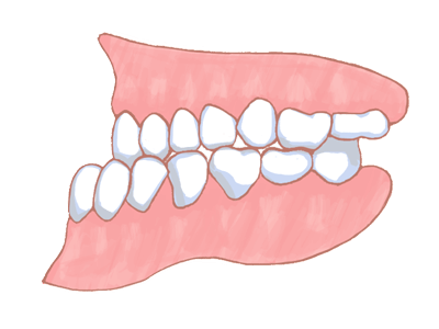 下顎前突（反対咬合・受け口）