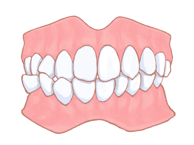 交叉咬合（こうさこうごう）・過蓋咬合（かがいこうごう）