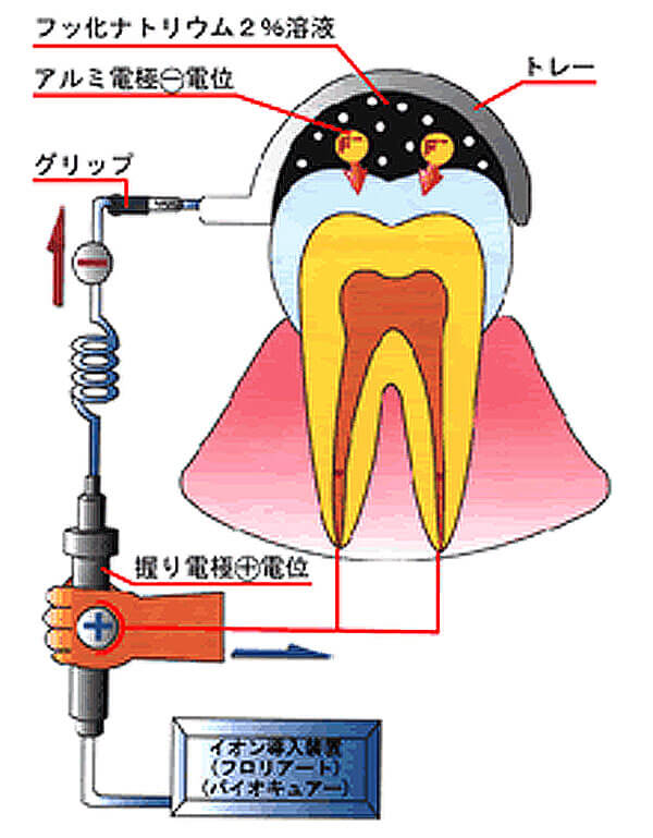 フッ素イオン導入法