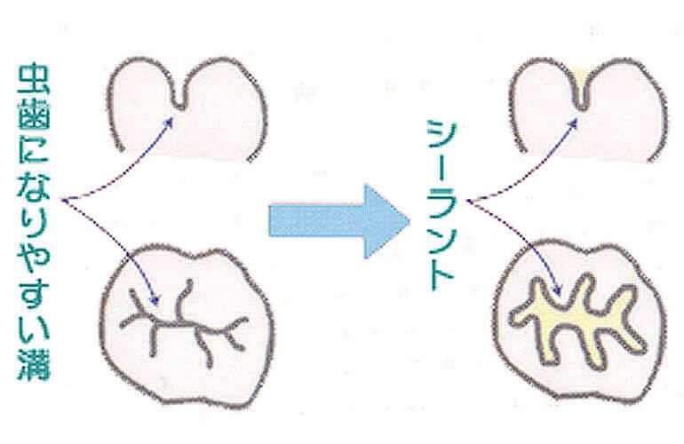 シーラント