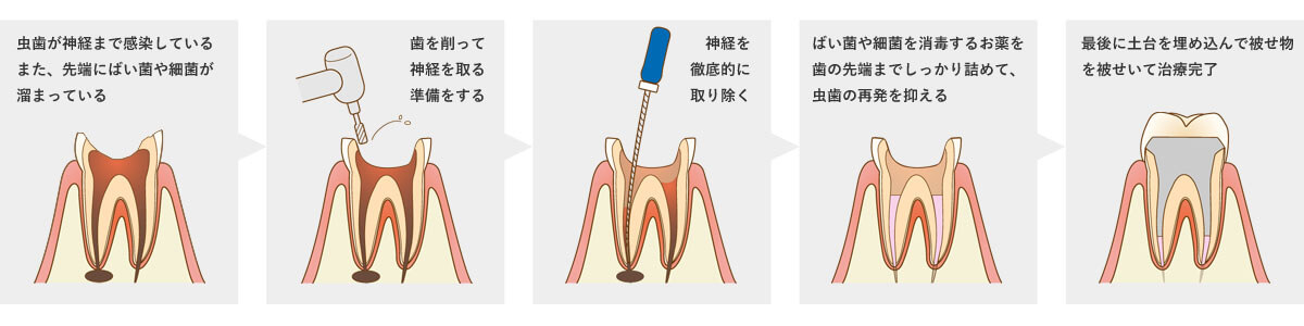 歯根治療・根管治療