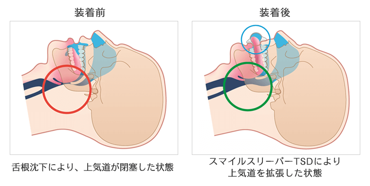 スマイルスリーパー装着前と装着後