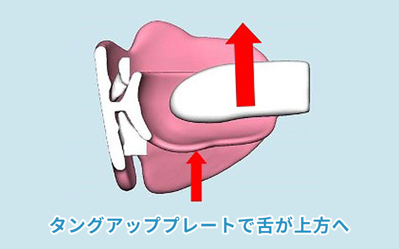 タングアッププレート