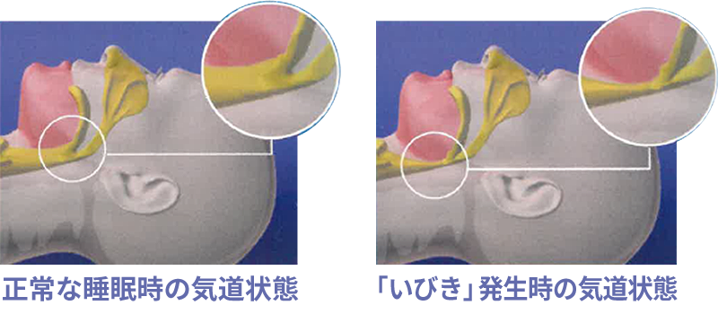 睡眠時無呼吸症