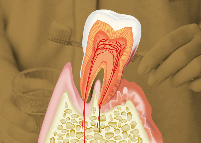 歯周病治療