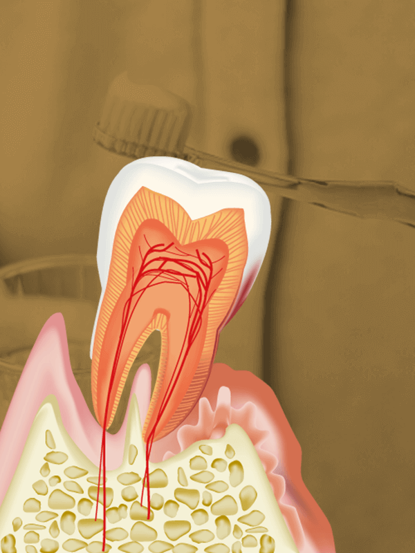 歯周病治療