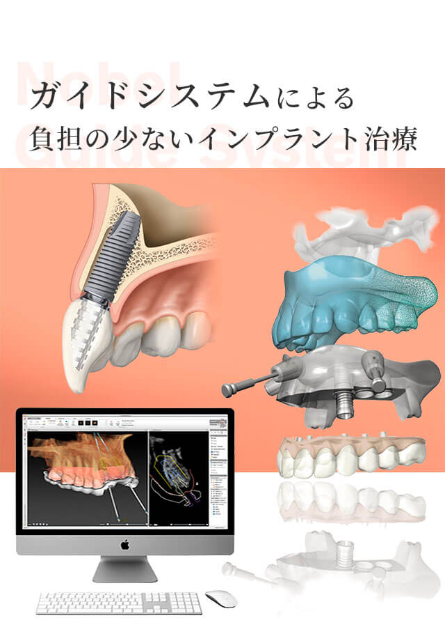 神戸市灘区 インプラント