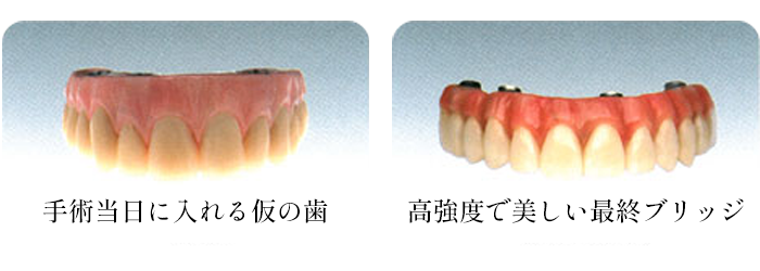 高強度で美しい最終ブリッジ