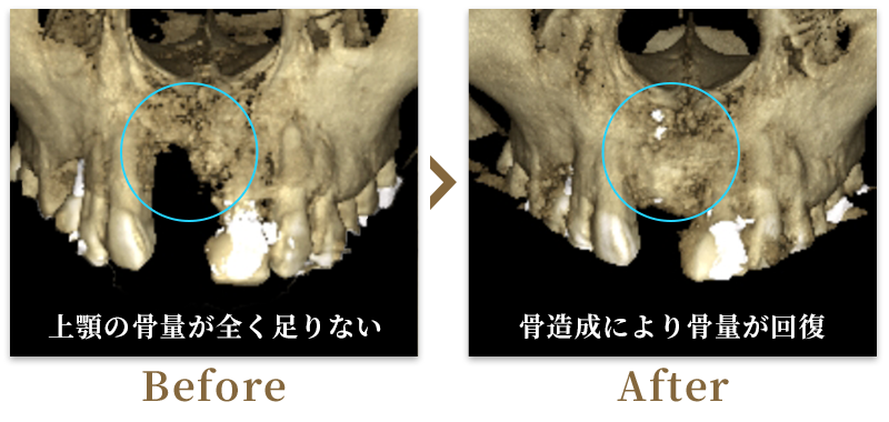 インプラント埋入+骨造成