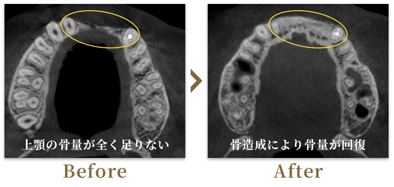 インプラント埋入+骨造成