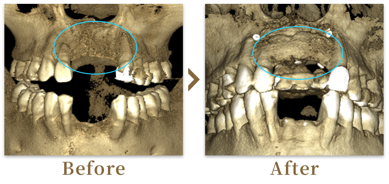 インプラント埋入+骨造成