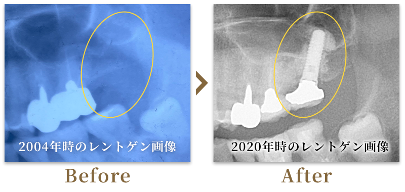 インプラント埋入