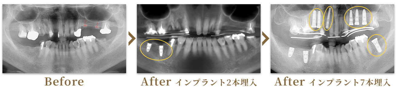 インプラント埋入