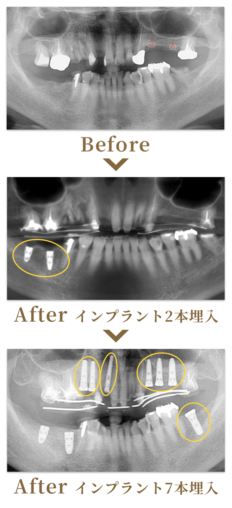 インプラント埋入