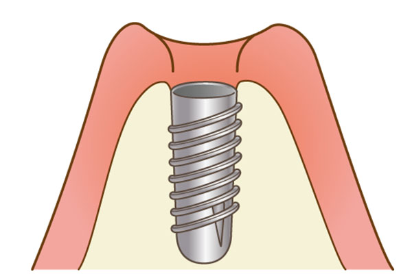 インプラント埋入手術