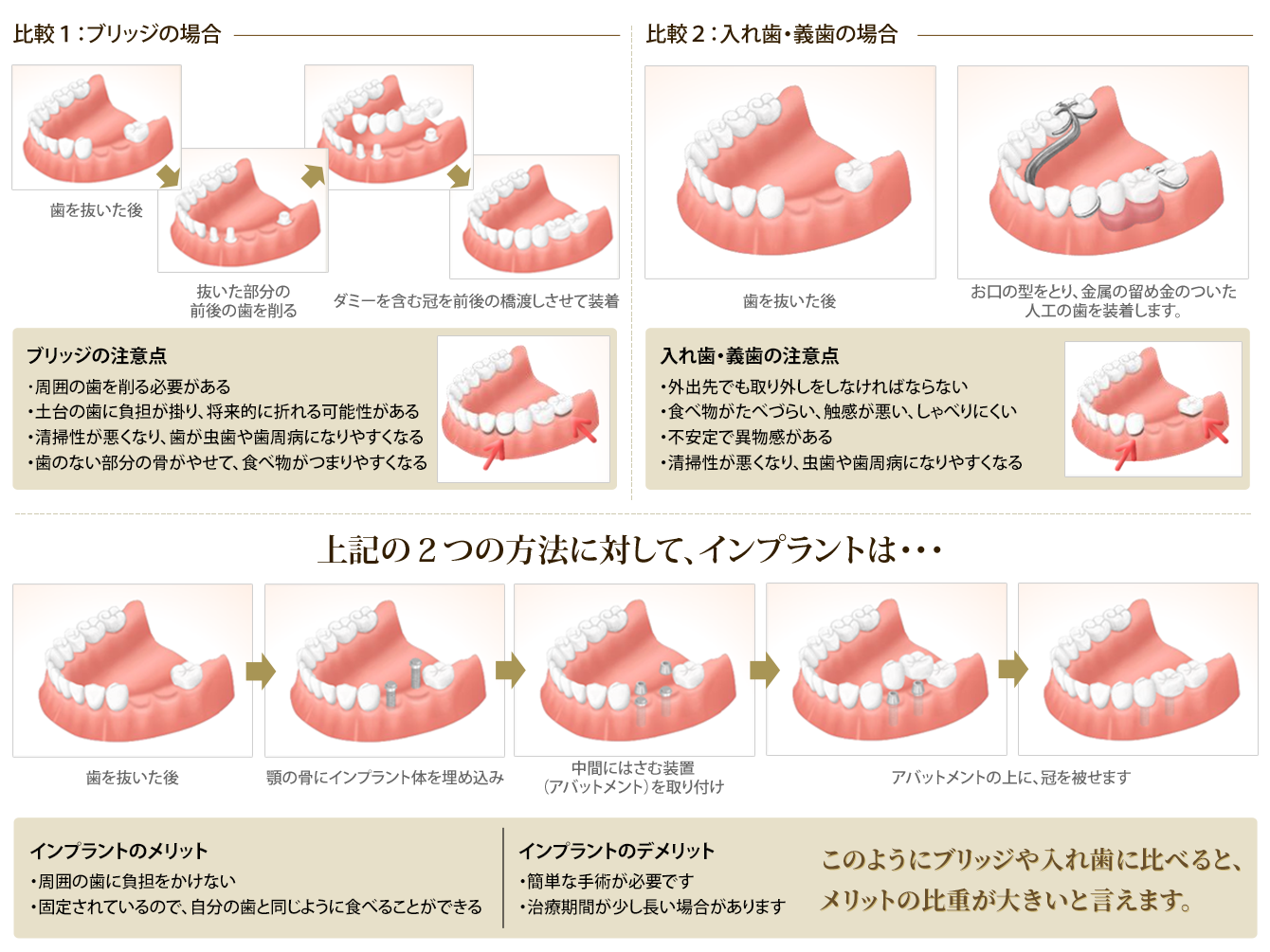 ブリッジと入れ歯（義歯）よりもインプラント