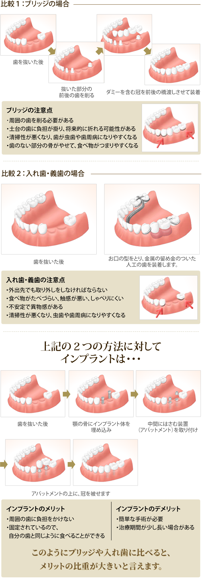 ブリッジと入れ歯（義歯）よりもインプラント