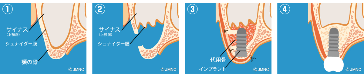 サイナスリフト法