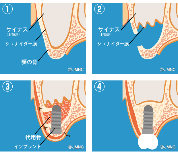 サイナスリフト法