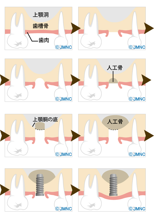 ソケットリフト法