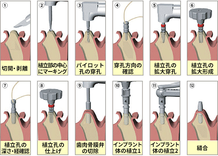 AQBインプラント1ピース植立の流れ