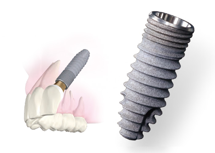 ボーンレベルタイプ