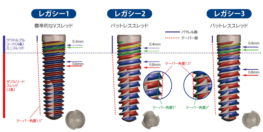 インプラントデザイン