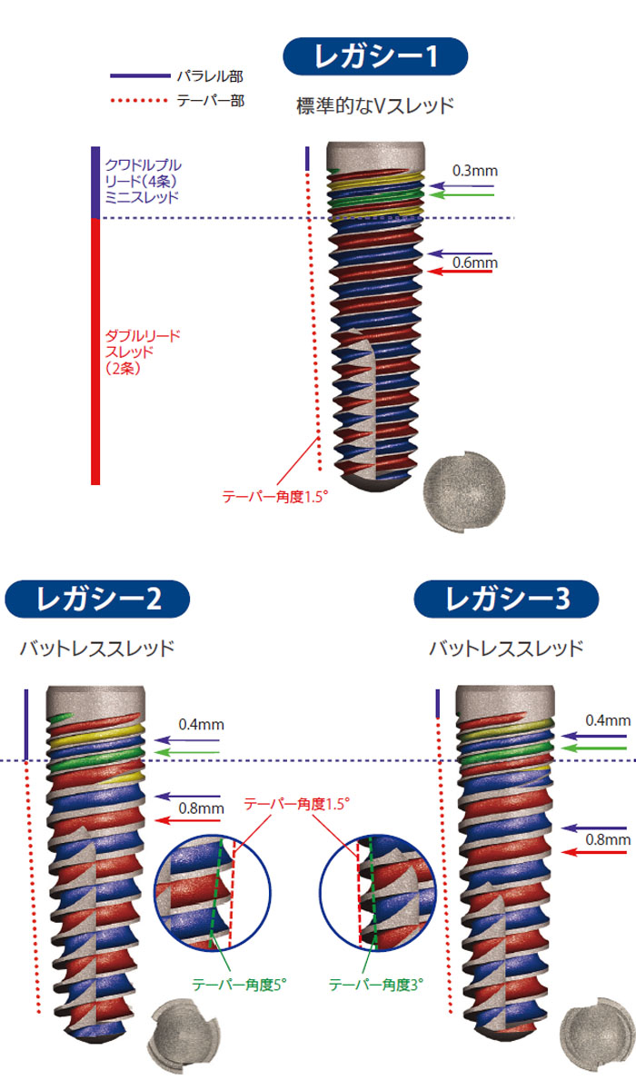 インプラントデザイン