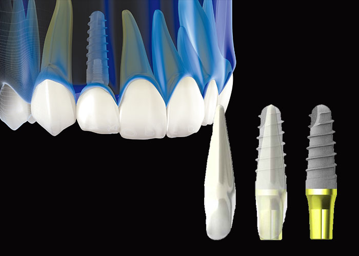 天然歯からインプラント治療へ