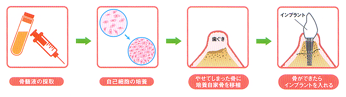 TE-BONEの治療の流れ