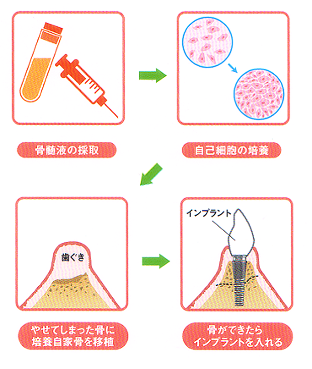 TE-BONEの治療の流れ