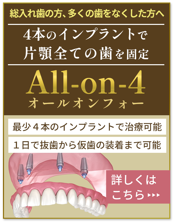 All-on-4（オールオンフォー）