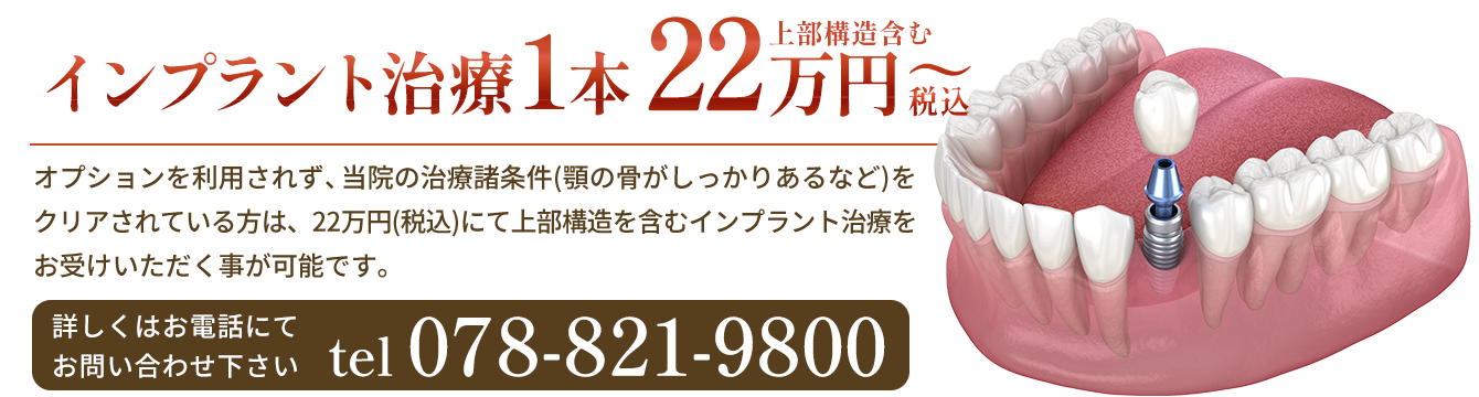 神戸 インプラント治療1本22万円