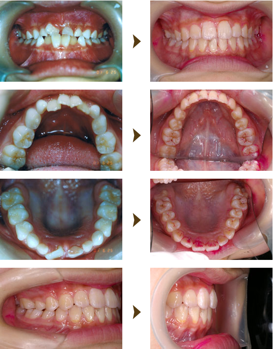 歯列育形成症例：1