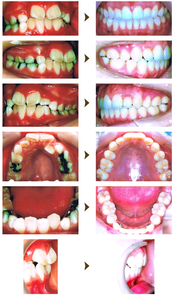 機能的矯正症例