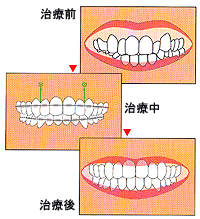 インプラント矯正