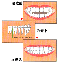 インプラント矯正