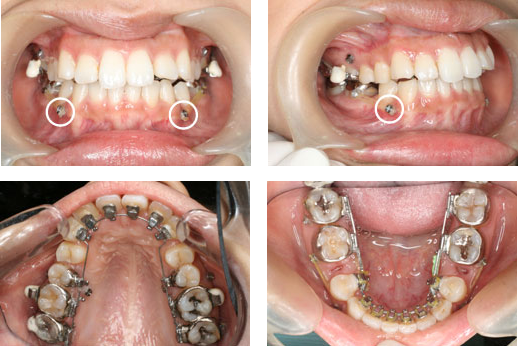 インプラント矯正症例：1