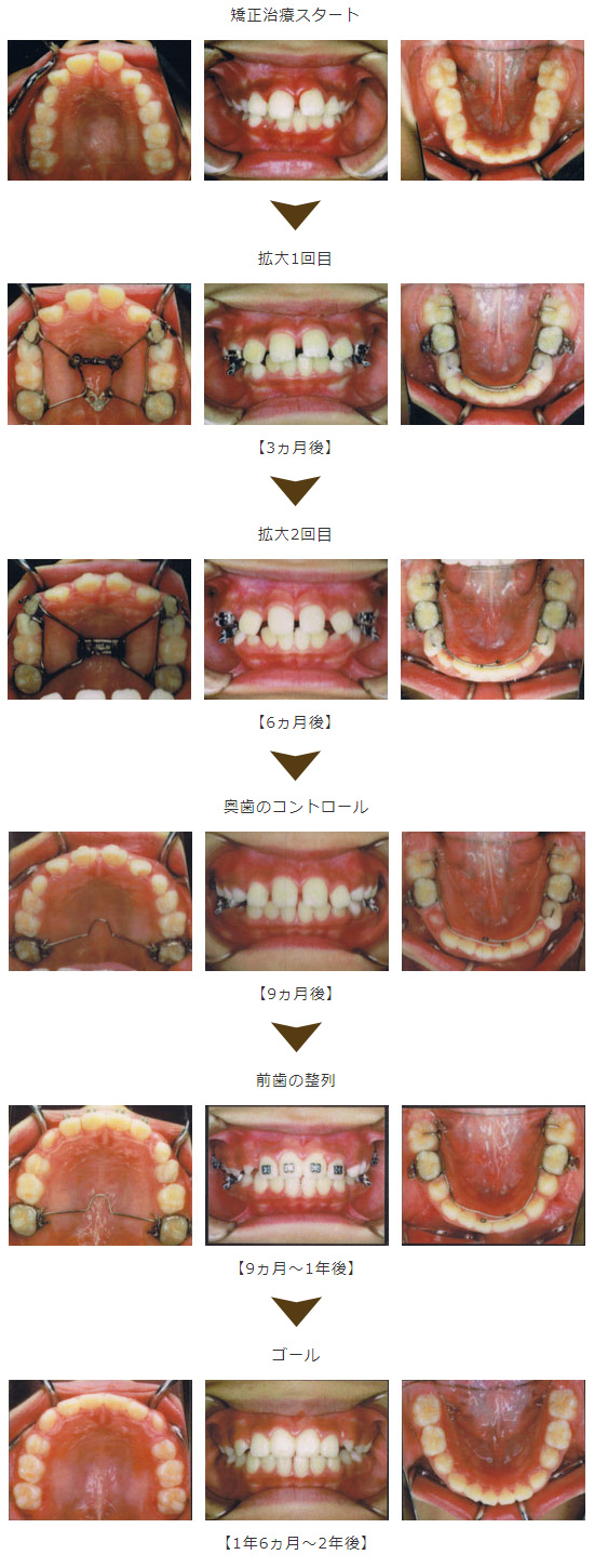 確実に顎を広げる矯正症例：1