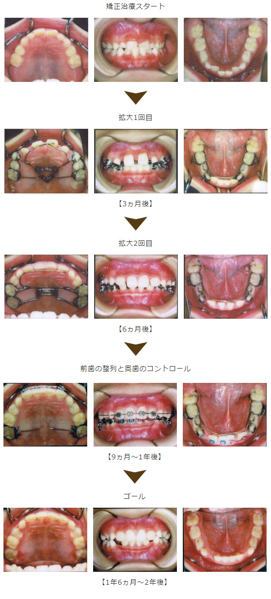 確実に顎を広げる矯正症例：2