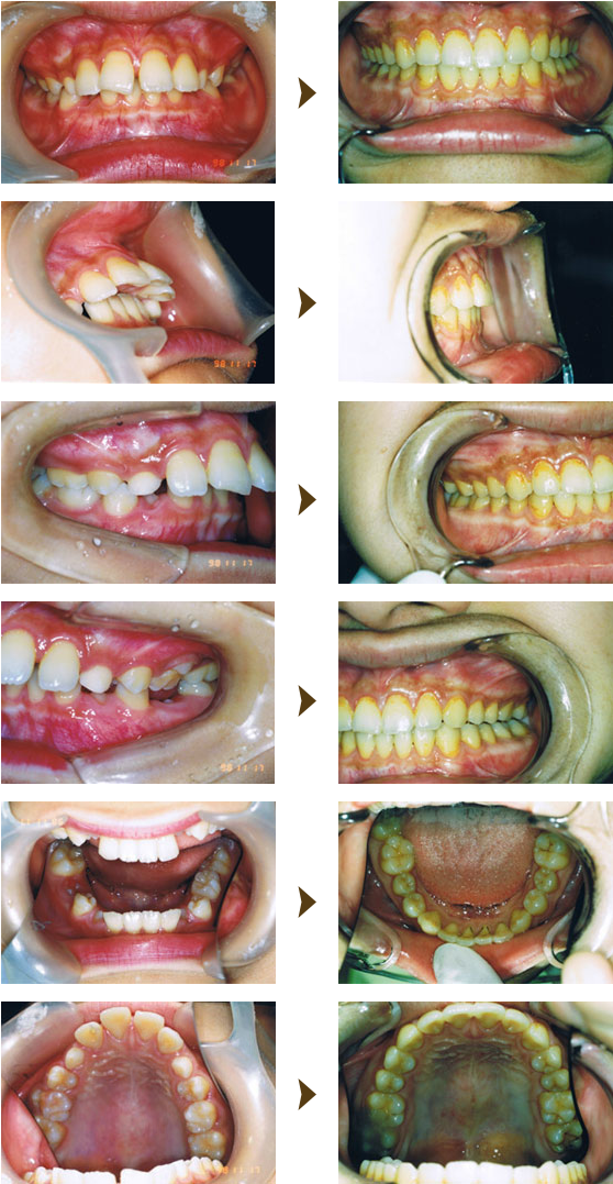 歯列育形成症例：3