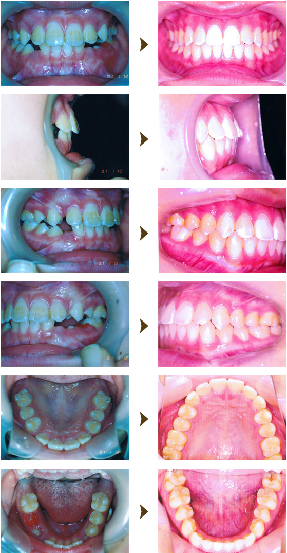 歯列育形成症例：5